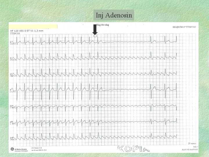 Inj Adenosin 