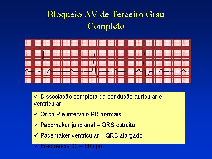 Bloqueio AV de Terceiro Grau Completo ü Dissociação completa da condução auricular e ventricular