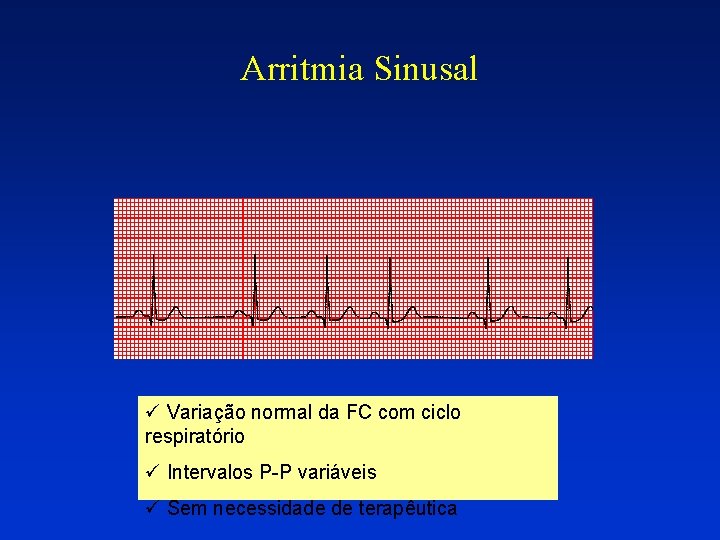 Arritmia Sinusal ü Variação normal da FC com ciclo respiratório ü Intervalos P-P variáveis