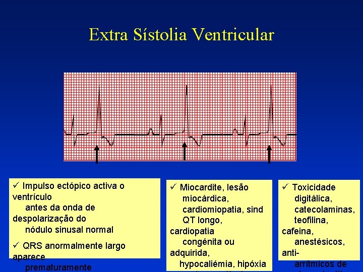 Extra Sístolia Ventricular ü Impulso ectópico activa o ventrículo antes da onda de despolarização