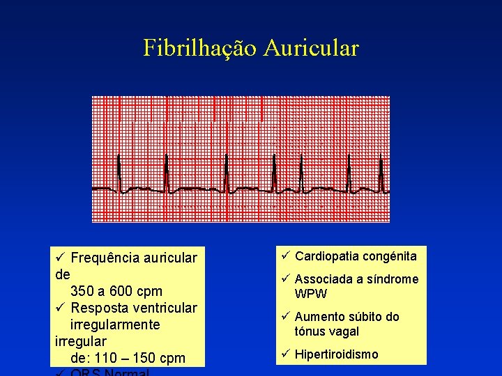 Fibrilhação Auricular ü Frequência auricular de 350 a 600 cpm ü Resposta ventricular irregularmente