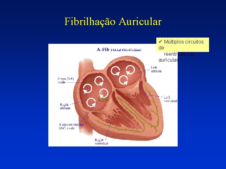 Fibrilhação Auricular ü Múltiplos circuitos de reentrada nas aurículas Fibrilhação Auricular ü Múltiplos circuitos de reentrada nas aurículas