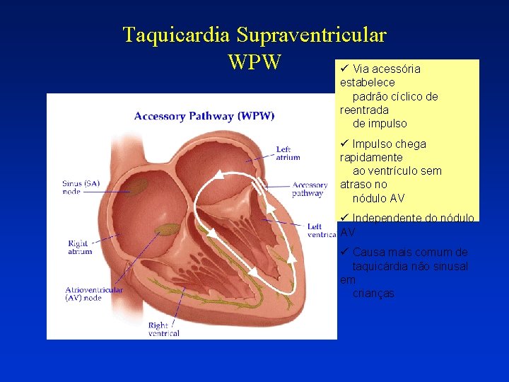 Taquicardia Supraventricular WPW ü Via acessória estabelece padrão cíclico de reentrada de impulso ü