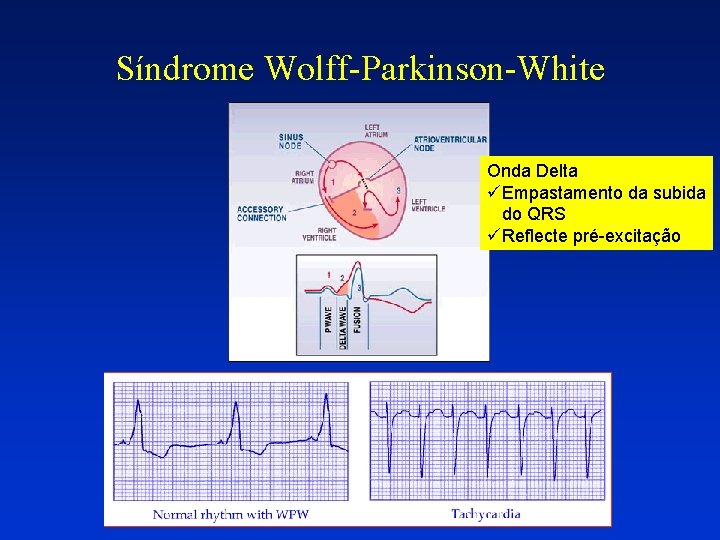 Síndrome Wolff-Parkinson-White Onda Delta üEmpastamento da subida do QRS üReflecte pré-excitação 