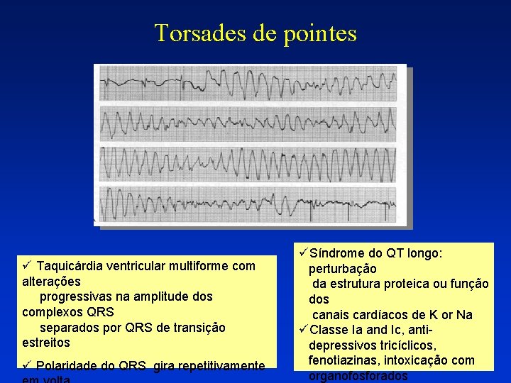 Torsades de pointes ü Taquicárdia ventricular multiforme com alterações progressivas na amplitude dos complexos