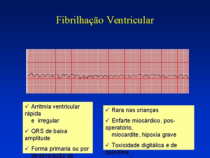 Fibrilhação Ventricular ü Arritmia ventricular rápida e irregular ü QRS de baixa amplitude ü