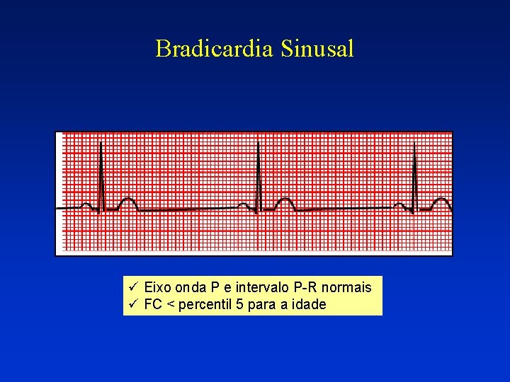 Bradicardia Sinusal ü Eixo onda P e intervalo P-R normais ü FC < percentil