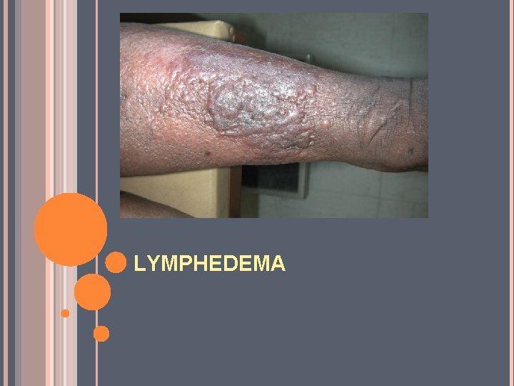 LYMPHEDEMA 