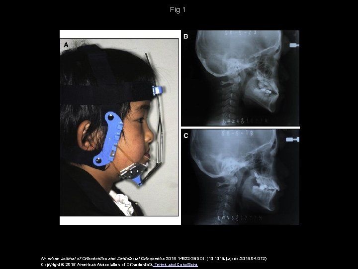 Fig 1 American Journal of Orthodontics and Dentofacial Orthopedics 2015 14822 -36 DOI: (10.