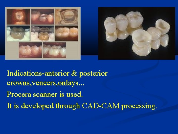 Indications-anterior & posterior crowns, veneers, onlays. . . Procera scanner is used. It is