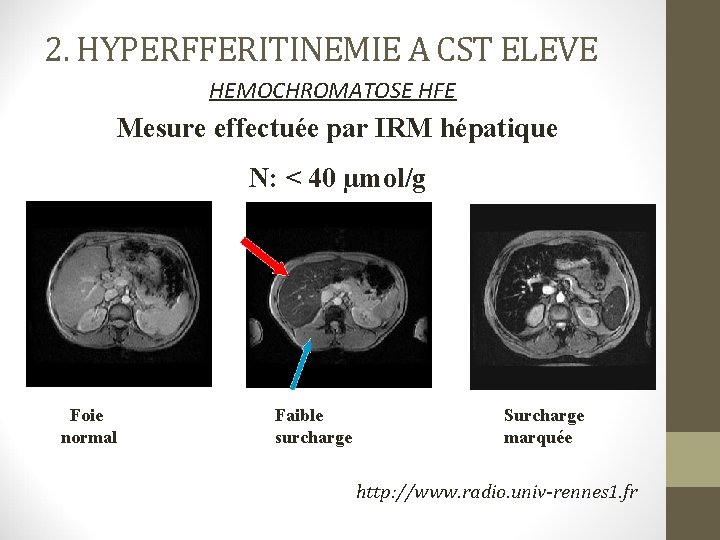 2. HYPERFFERITINEMIE A CST ELEVE HEMOCHROMATOSE HFE Mesure effectuée par IRM hépatique N: <