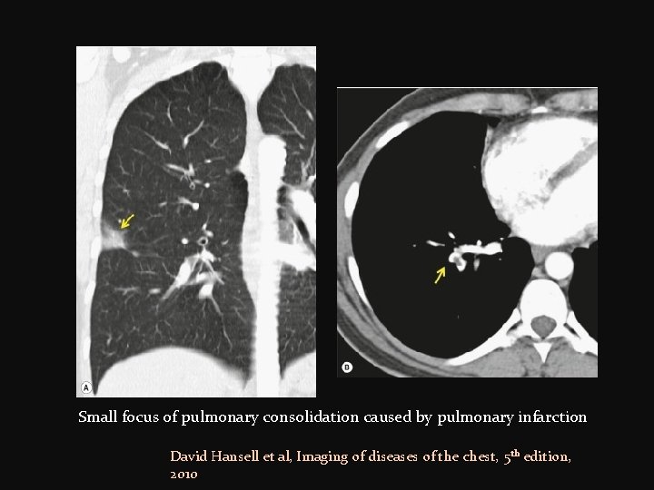 Small focus of pulmonary consolidation caused by pulmonary infarction David Hansell et al, Imaging