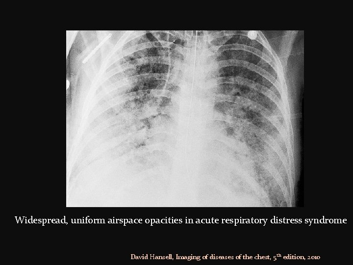 Widespread, uniform airspace opacities in acute respiratory distress syndrome David Hansell, Imaging of diseases
