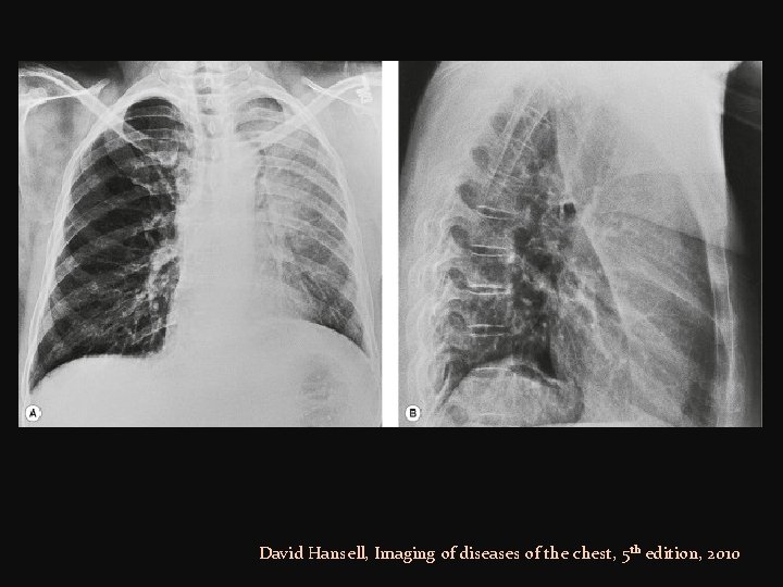 David Hansell, Imaging of diseases of the chest, 5 th edition, 2010 