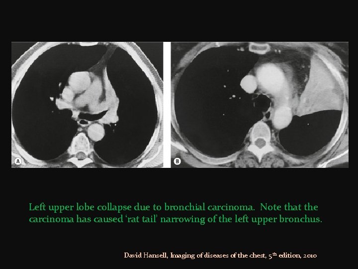 Left upper lobe collapse due to bronchial carcinoma. Note that the carcinoma has caused
