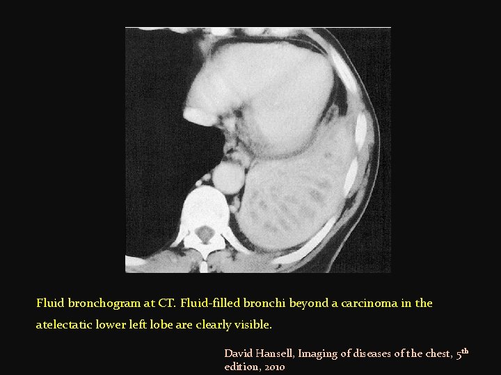 Fluid bronchogram at CT. Fluid-filled bronchi beyond a carcinoma in the atelectatic lower left