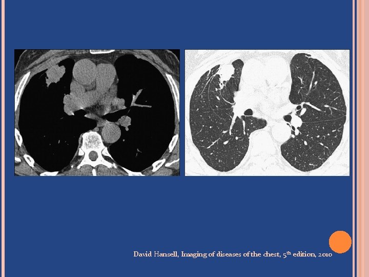 David Hansell, Imaging of diseases of the chest, 5 th edition, 2010 