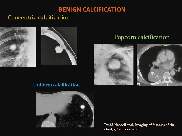 BENIGN CALCIFICATION Concentric calcification Popcorn calcification Uniform calcification David Hansell et al, Imaging of