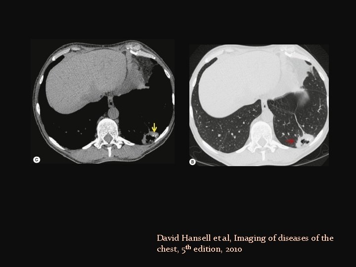 David Hansell et al, Imaging of diseases of the chest, 5 th edition, 2010