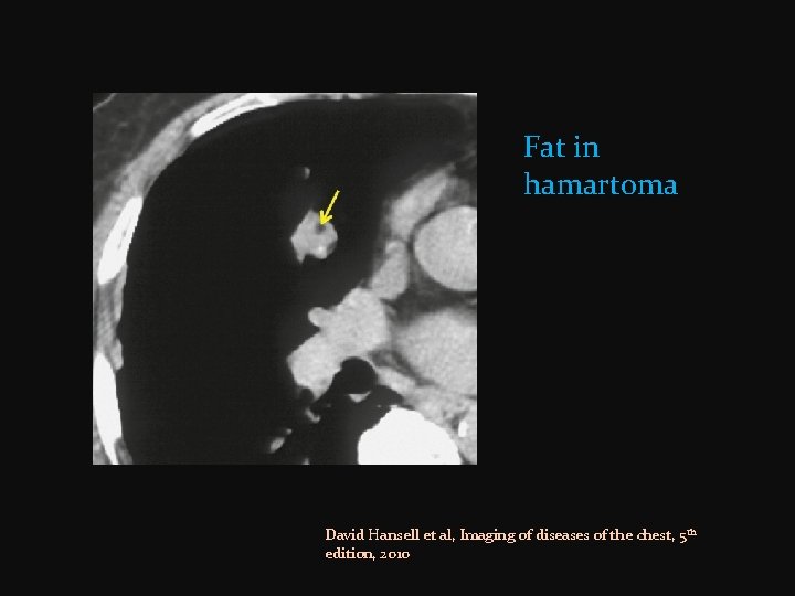 Fat in hamartoma David Hansell et al, Imaging of diseases of the chest, 5