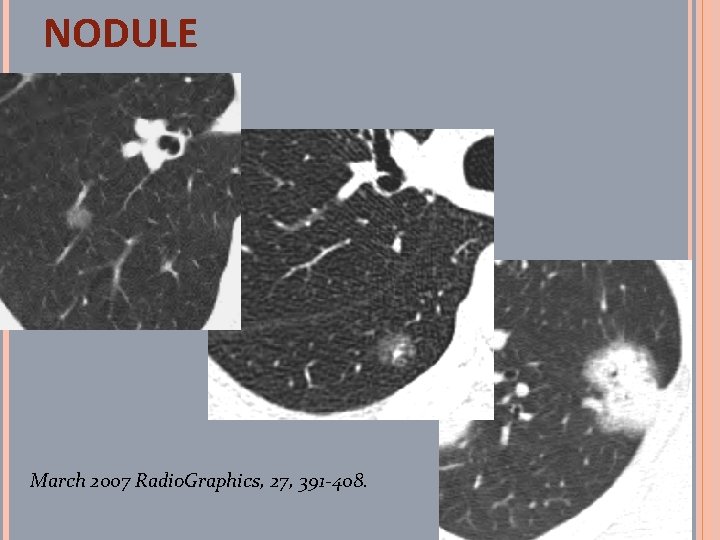 NODULE March 2007 Radio. Graphics, 27, 391 -408. 