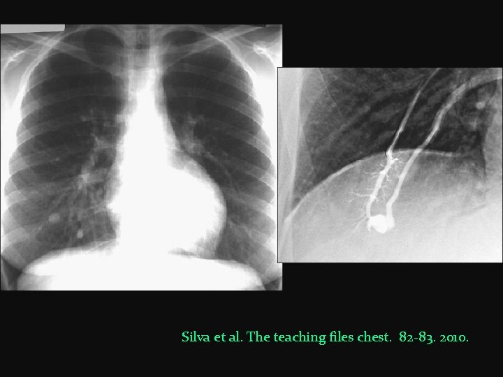 Silva et al. The teaching files chest. 82 -83. 2010. 