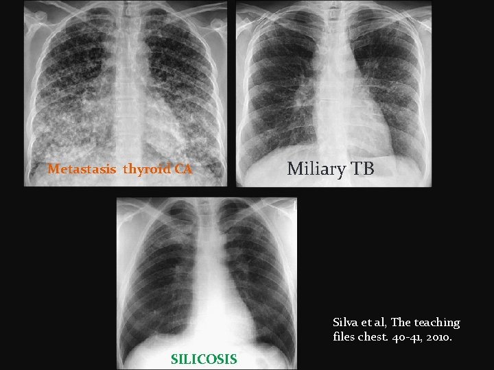 Metastasis thyroid CA Miliary TB Silva et al, The teaching files chest. 40 -41,