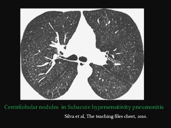 Centrilobular nodules in Subacute hypersensitivity pneumonitis Silva et al, The teaching files chest, 2010.