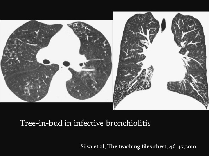 Tree-in-bud in infective bronchiolitis Silva et al, The teaching files chest, 46 -47, 2010.