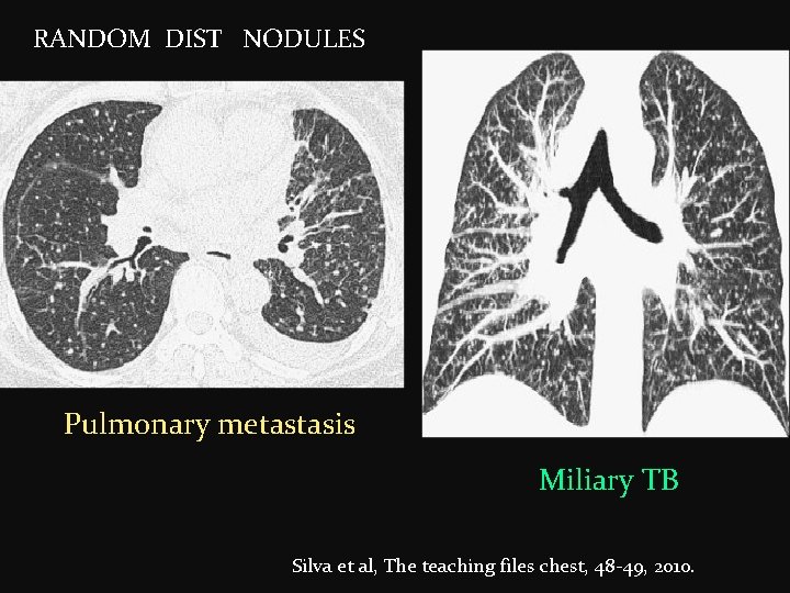 RANDOM DIST NODULES Pulmonary metastasis Miliary TB Silva et al, The teaching files chest,