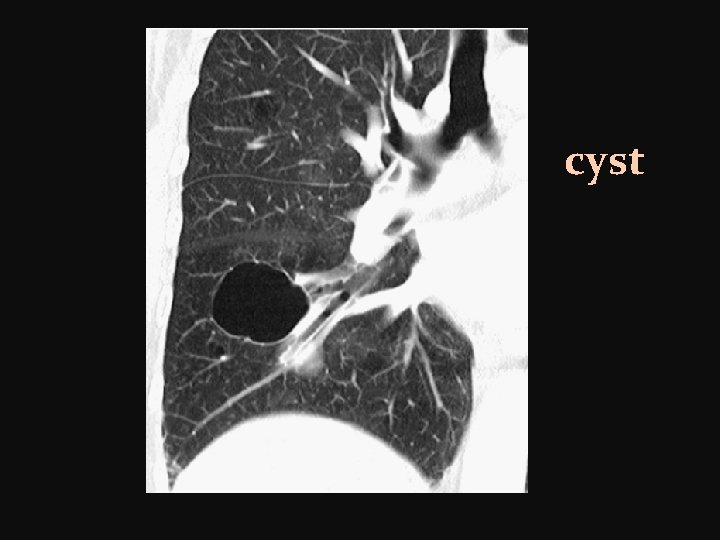 cyst 