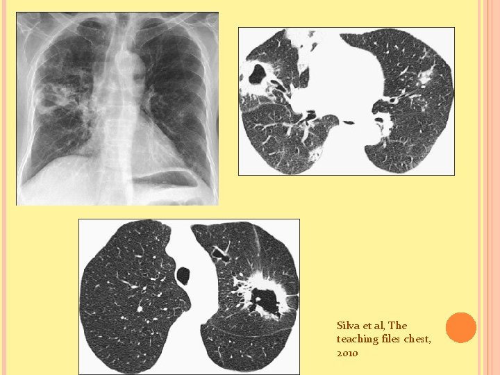 Silva et al, The teaching files chest, 2010 