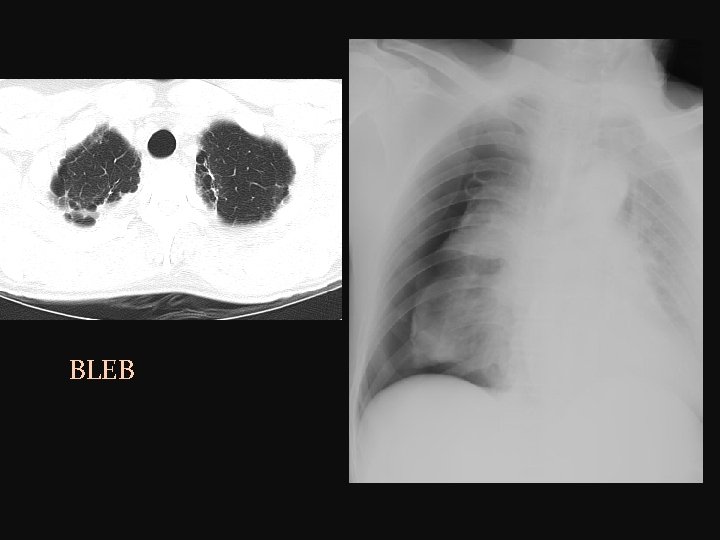 BLEB 