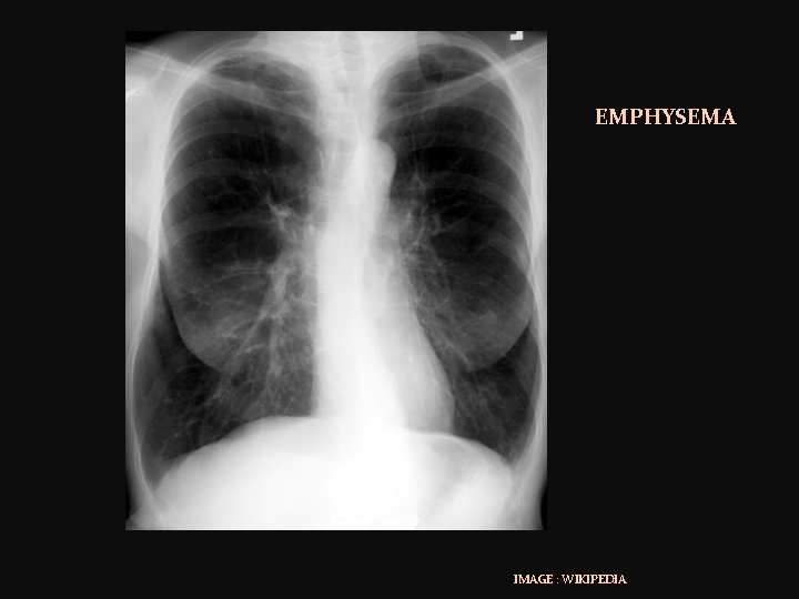 EMPHYSEMA IMAGE : WIKIPEDIA 