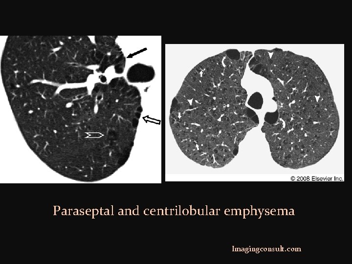  Paraseptal and centrilobular emphysema Imagingconsult. com 
