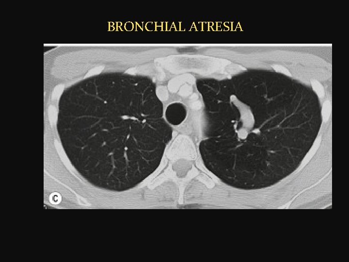  BRONCHIAL ATRESIA 