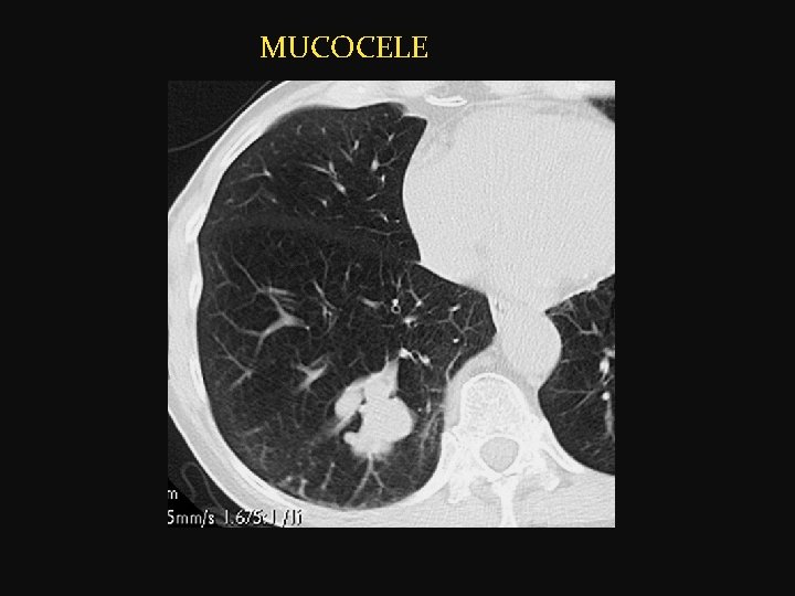  MUCOCELE 