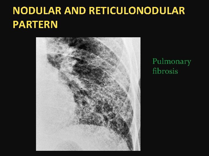 NODULAR AND RETICULONODULAR PARTERN Pulmonary fibrosis 