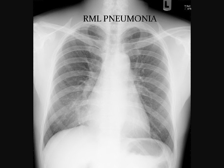  RML PNEUMONIA 