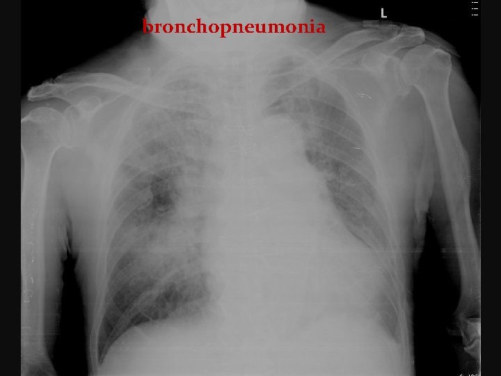 bronchopneumonia 