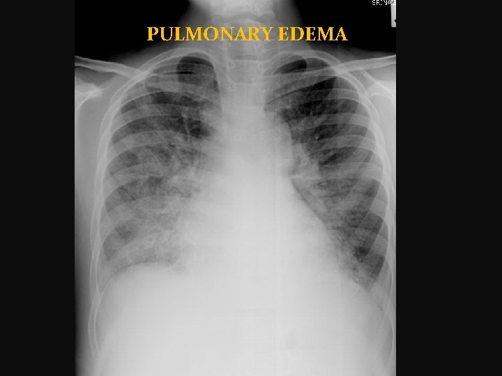PULMONARY EDEMA 