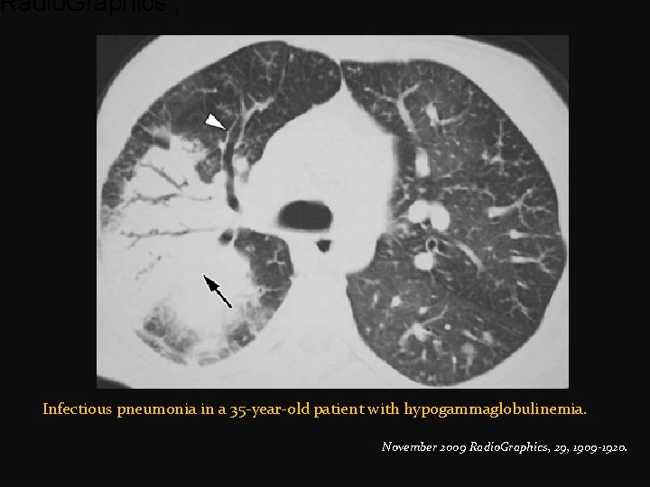 Radio. Graphics , Infectious pneumonia in a 35 -year-old patient with hypogammaglobulinemia. November 2009