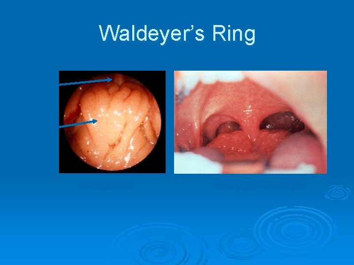Waldeyer’s Ring Septum Adenoid Lingual Tonsils 