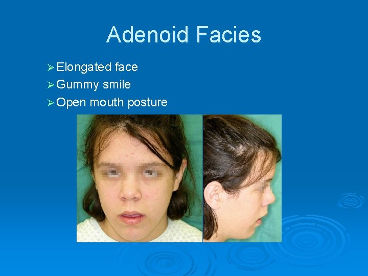 Adenoid Facies Ø Elongated face Ø Gummy smile Ø Open mouth posture 