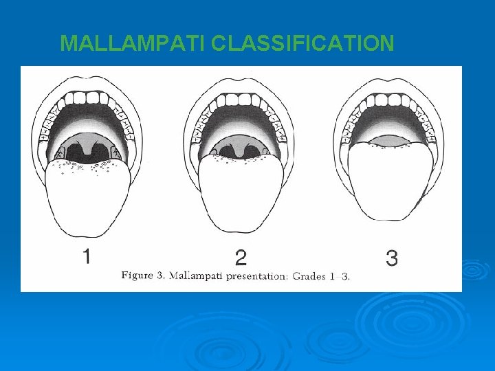 MALLAMPATI CLASSIFICATION 
