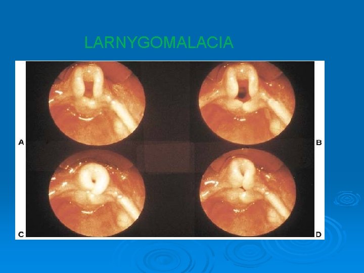 LARNYGOMALACIA 