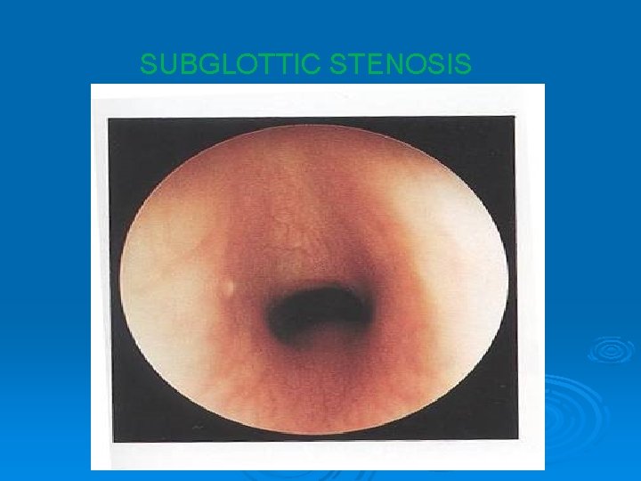SUBGLOTTIC STENOSIS 