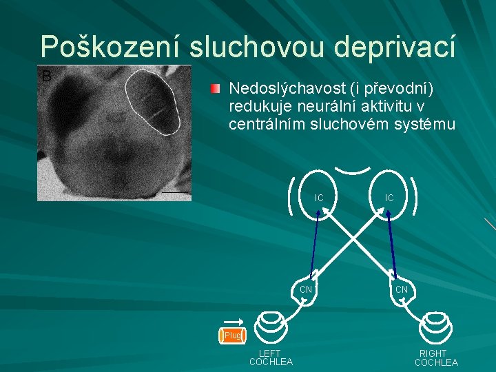 Poškození sluchovou deprivací Nedoslýchavost (i převodní) redukuje neurální aktivitu v centrálním sluchovém systému IC