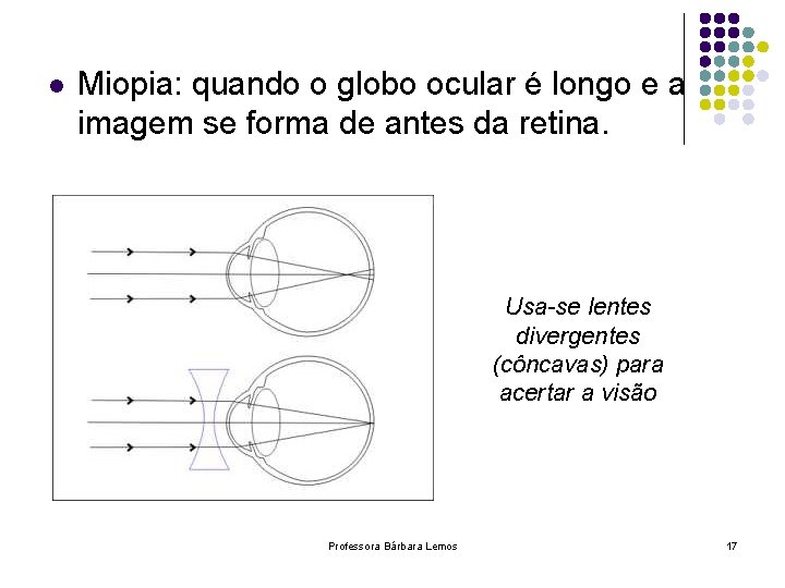 l Miopia: quando o globo ocular é longo e a imagem se forma de