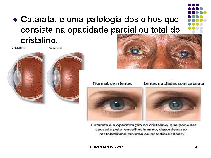 l Catarata: é uma patologia dos olhos que consiste na opacidade parcial ou total